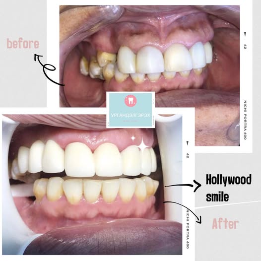 Urgandelgerekh Dental Before